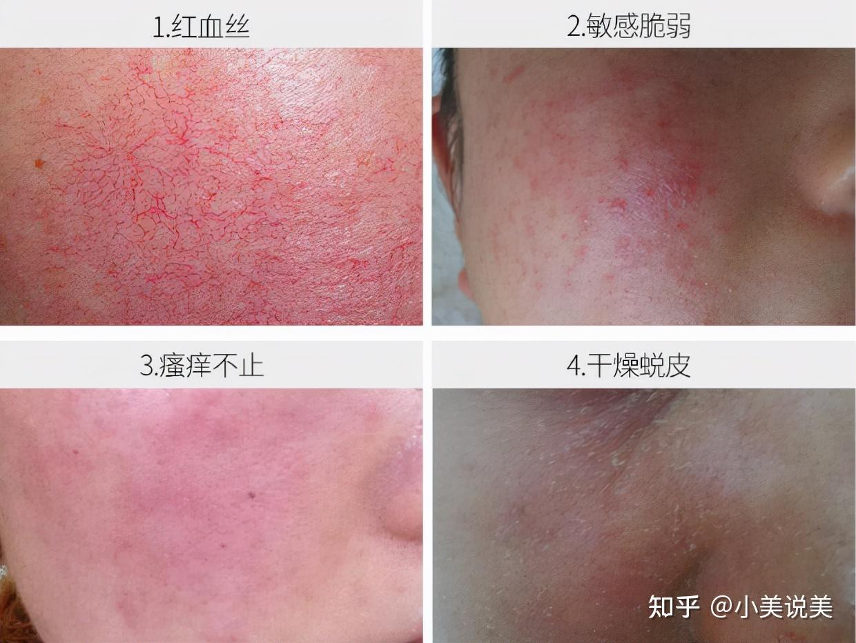 爆痘粗糙红痒你皮肤屏障受损了