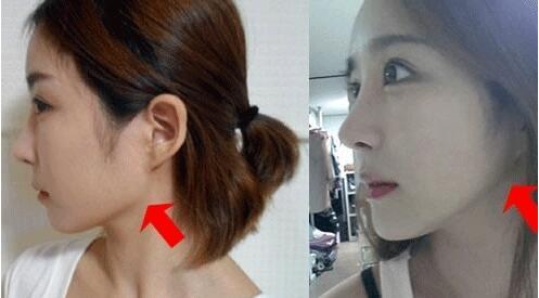 问:做了下颌角手术,皮肤就会变松弛下垂?