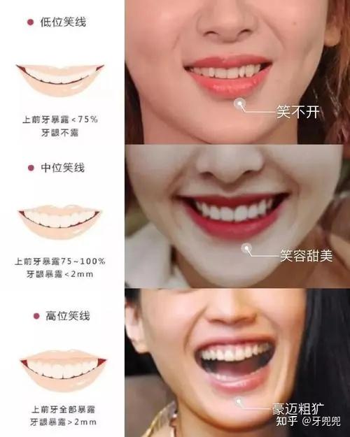 牙齿整齐，但笑起来不好看是怎么回事？ - 知乎