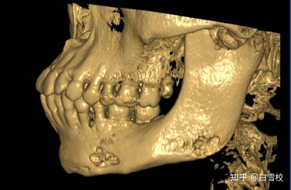 左下颌骨体部及角部骨质吸收破坏随着更多的患者被正确诊断,相信口 