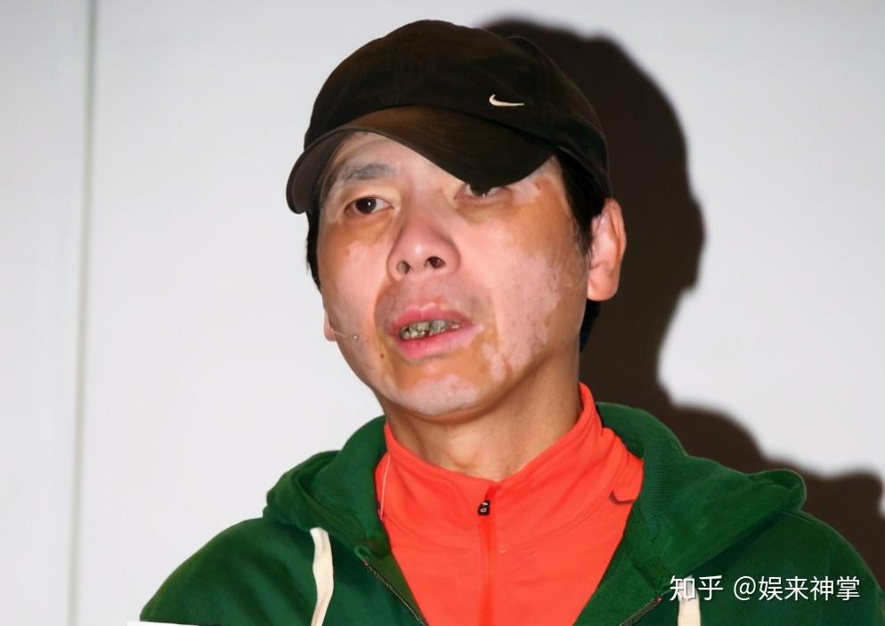 冯小刚近照斑秃严重脸色惨白一脸病态显苍老被白癜风折磨多年