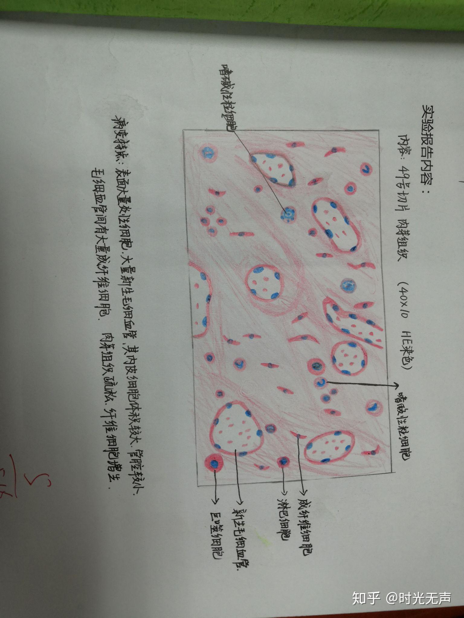 这学期病理手绘图,老师总给5-,我被宫颈原位癌难到了