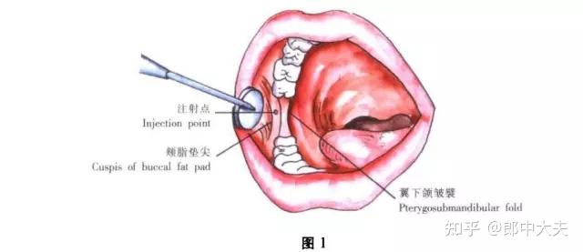 【十一】咀嚼肌神經阻滯麻醉1.進針點:同下頜神經卵圓孔注射法.2.