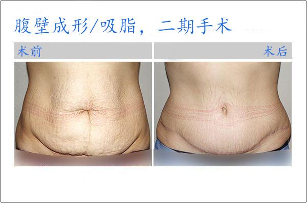 很多人担心先做腹壁成形再做吸脂,吸脂后又会出现皮肤松弛.