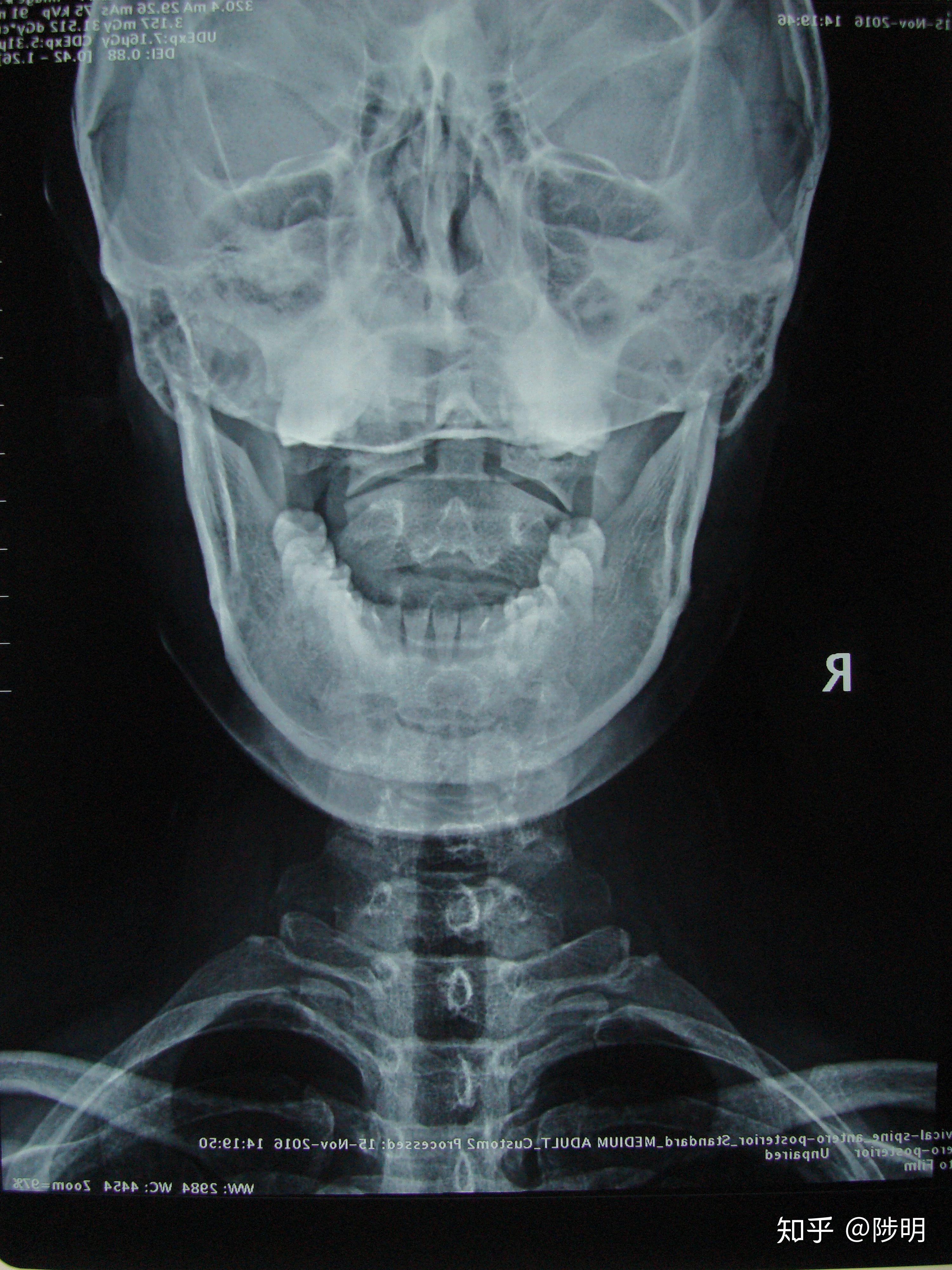 完整颈椎正位,开口看到枕骨大孔和双侧枕骨髁,颞骨乳突,完整的枢椎齿