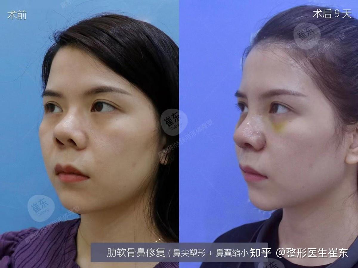 北京做鼻综合术后案例分享-蜜颜优惠
