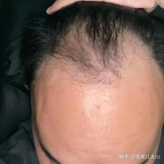 植发2400元(植发4500者亲历)