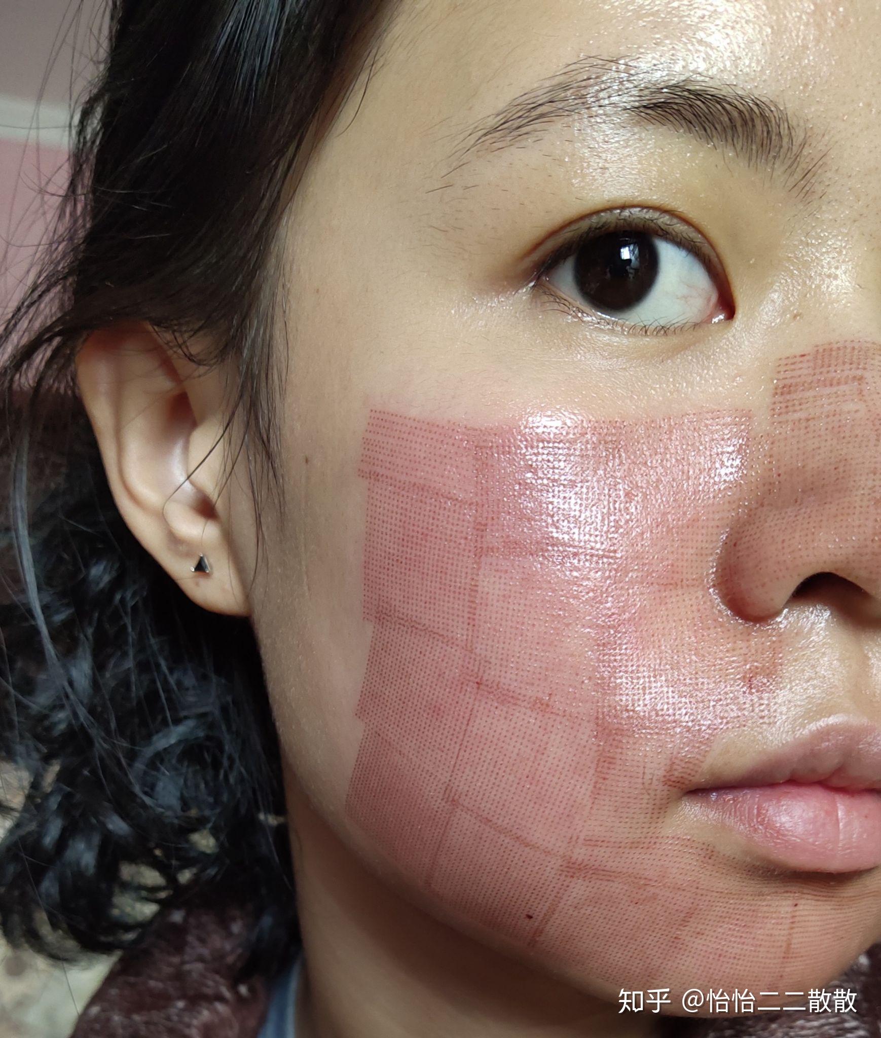 第一次点阵激光记录贴