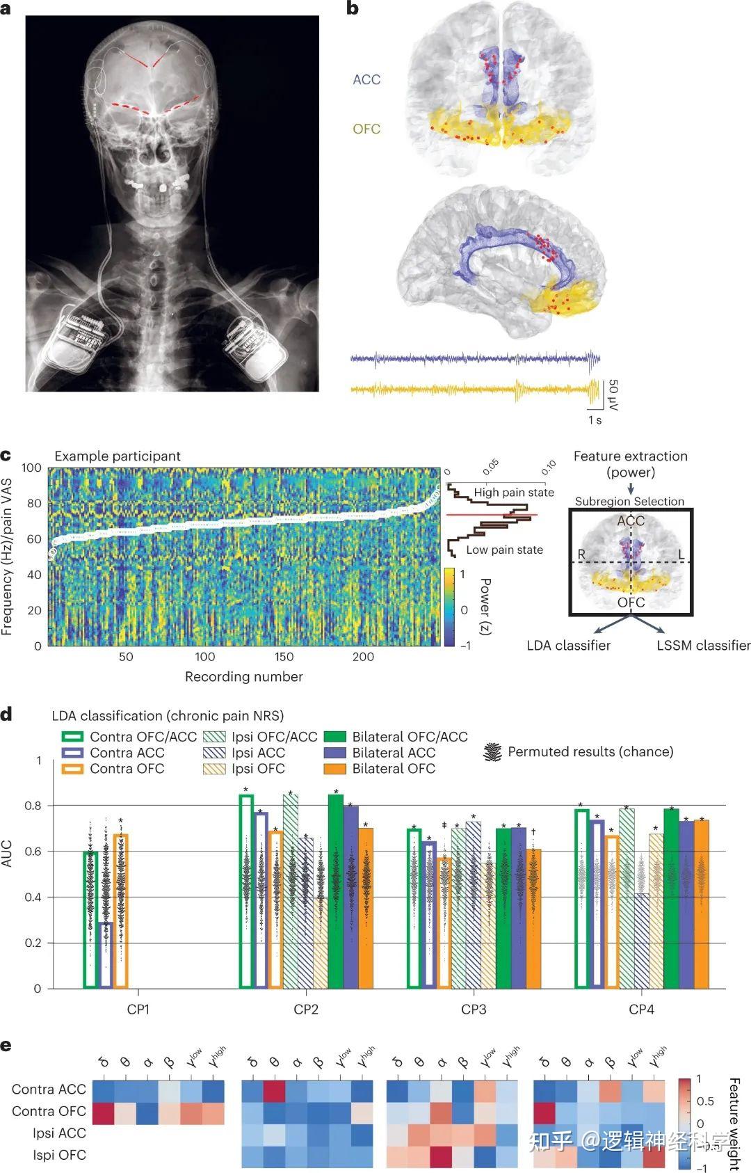Nat Neurosci︱重大发现！首次使用颅内神经生物标志物预测慢性疼痛状态- 知乎
