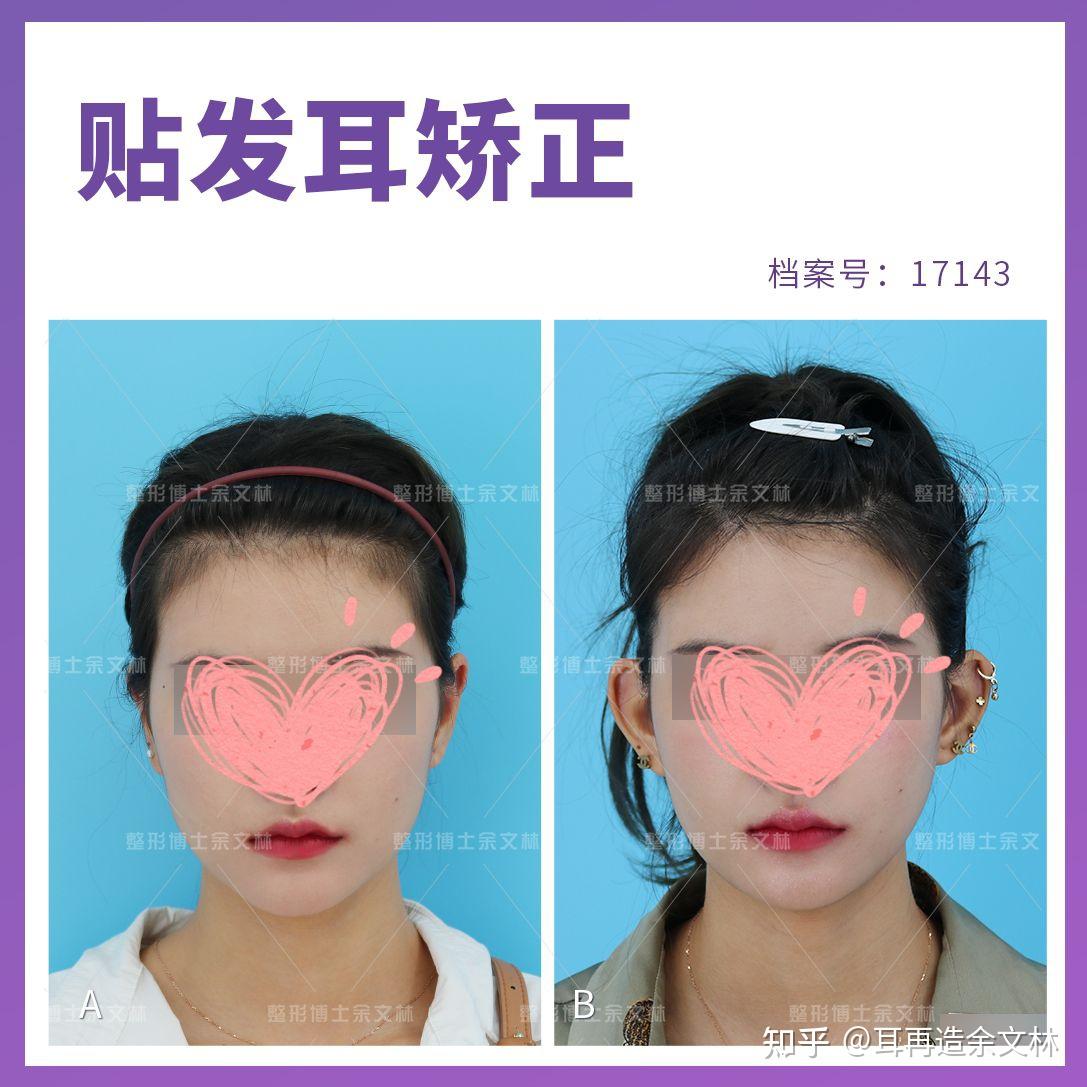 贴发耳看了这么多艺人证件照好像没有耳朵贴面的明星