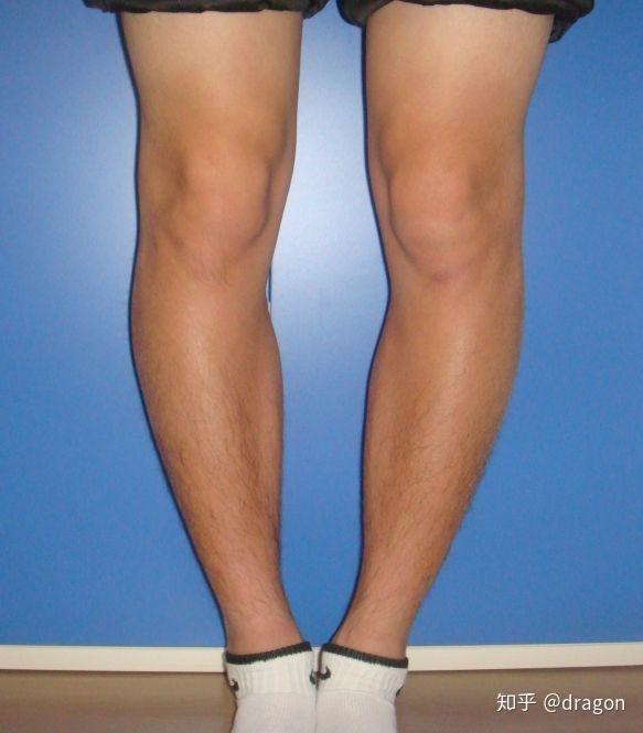 o型腿,很简单,当你把两只脚并起来的时候,如果你发现你的小腿之间存在