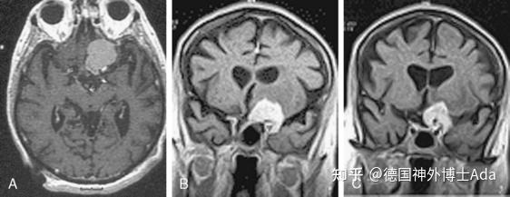 脑膜瘤的临床表现有哪些？详细解读不同位置脑膜瘤症状 知乎