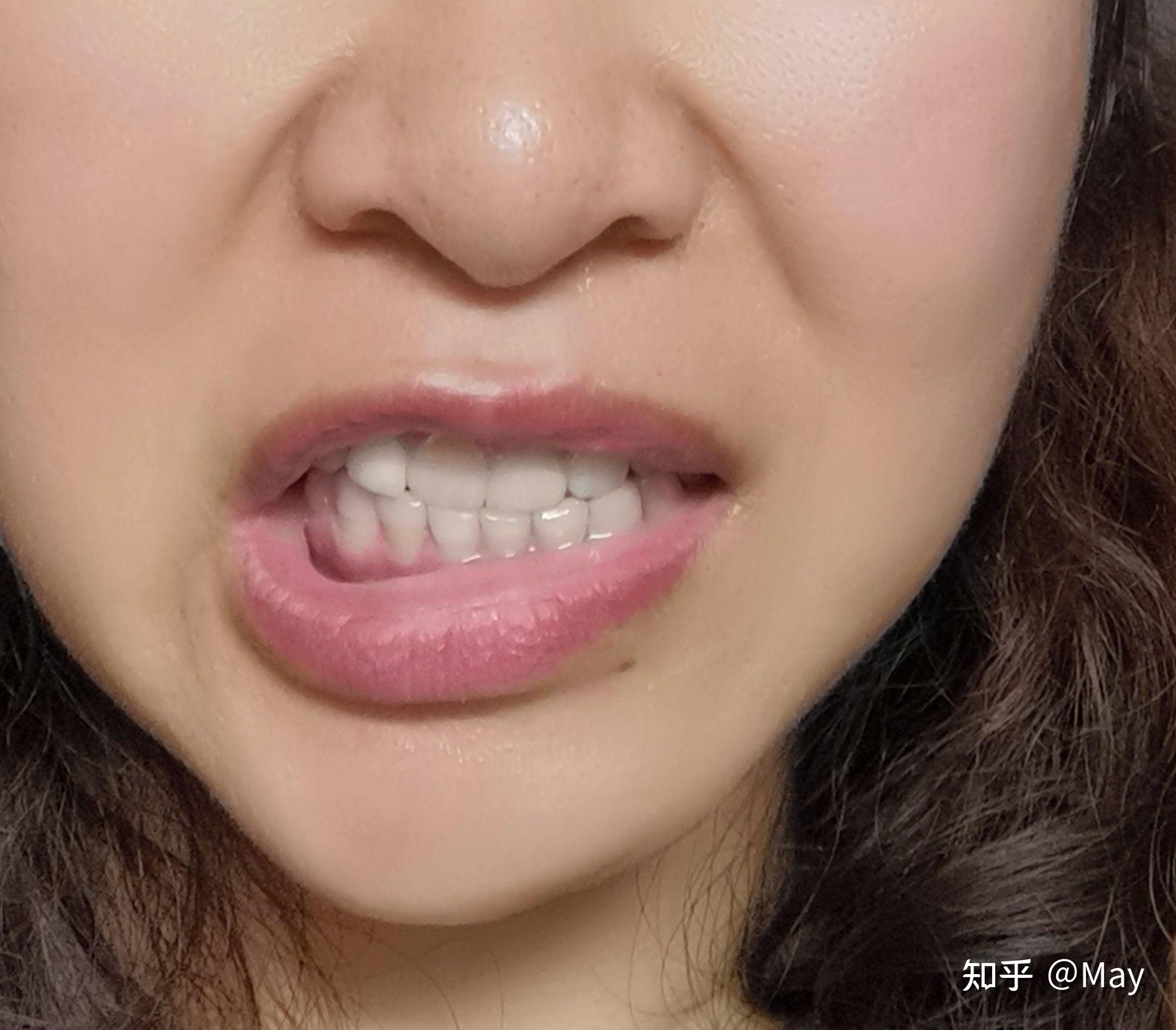 百元治疗面瘫日记