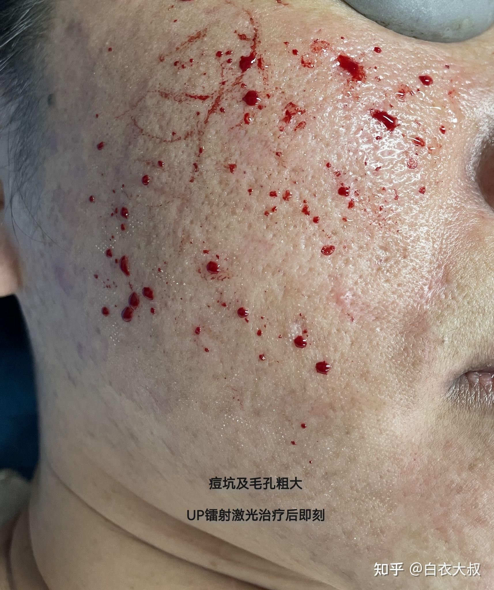 临床治疗分享up镭射激光治疗痘坑