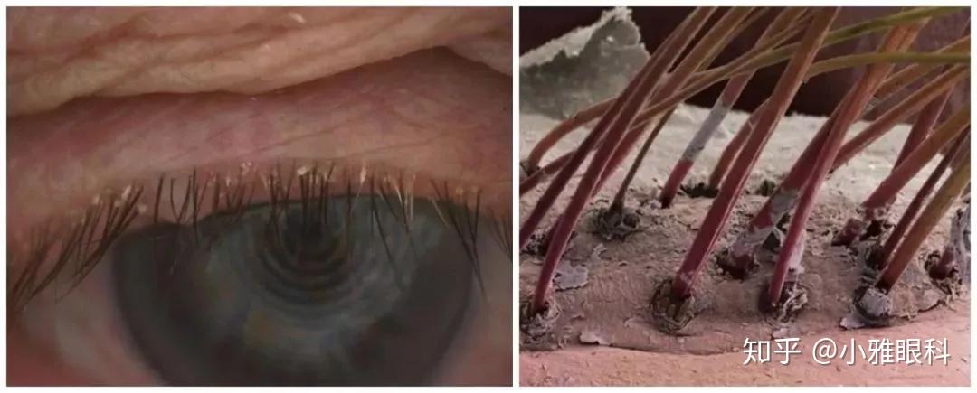 蠕形螨寄生于睫毛毛囊及皮脂腺内,刺吸皮脂腺,角质蛋白为食,并可吞食