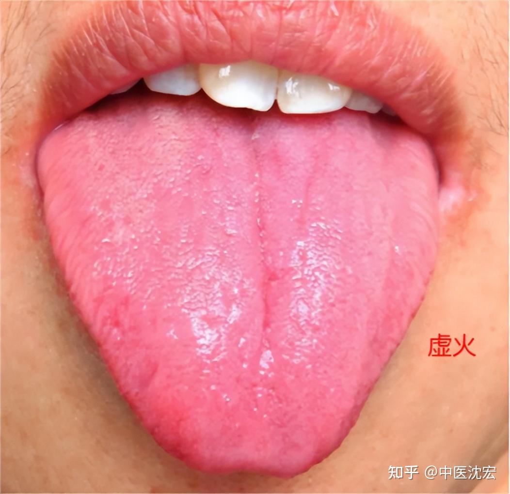 图233 舌下络脉怒张(1)-中医学-医学