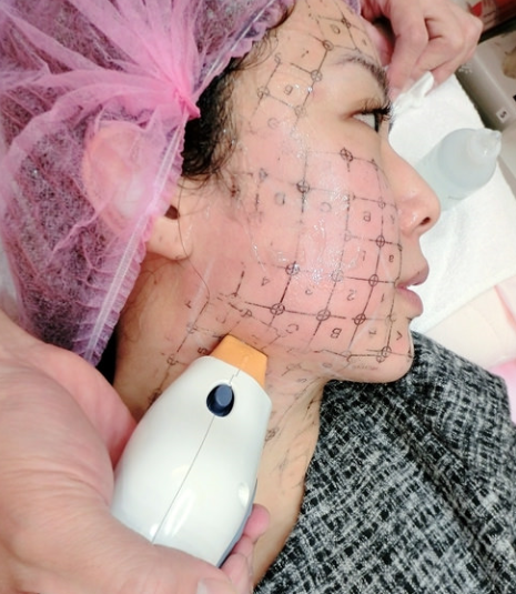 电波拉皮的效果怎么样