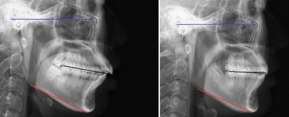 嘴突下巴后缩是需要正畸还是正颌为什么有些人正畸后下巴改变会那么大