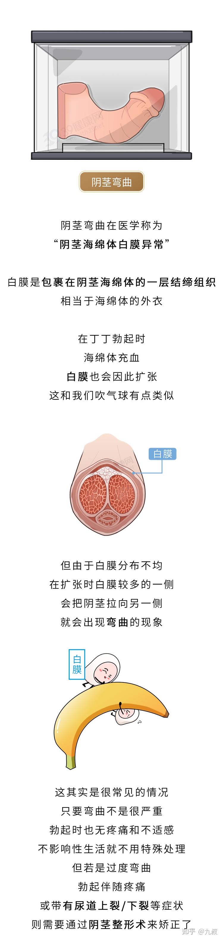 阴痉是什么图片