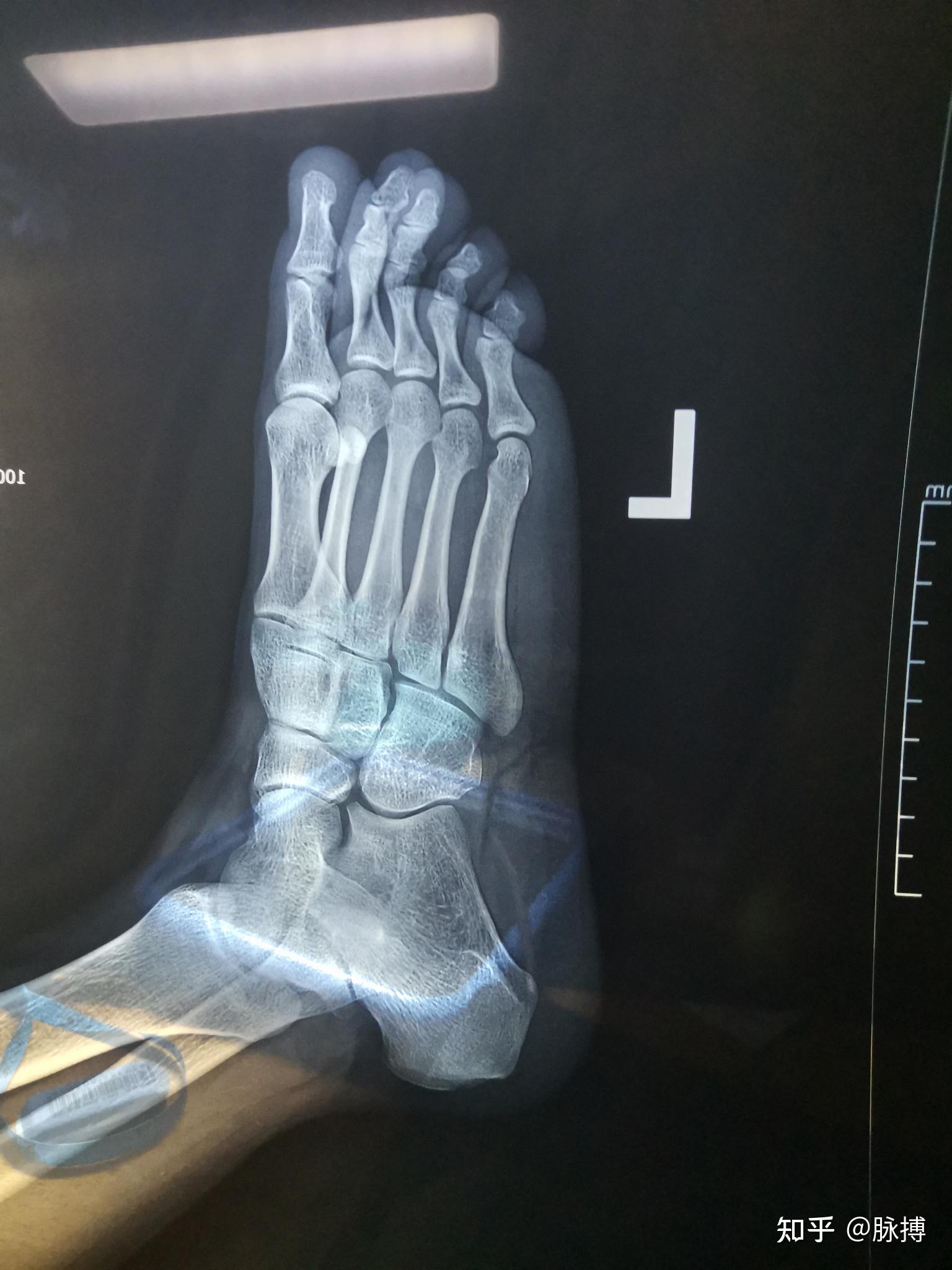 骨折的日子 - 知乎