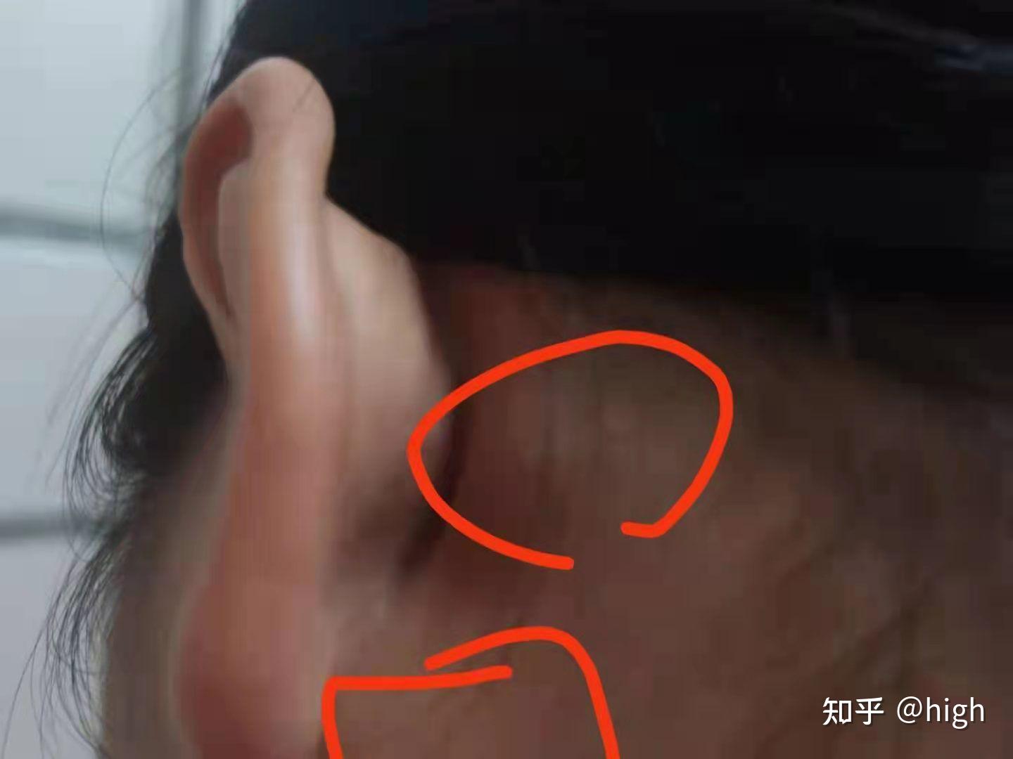 到了晚上,我摸了摸耳朵后面发现起了两个鼓包,上网一查,这大概是淋巴