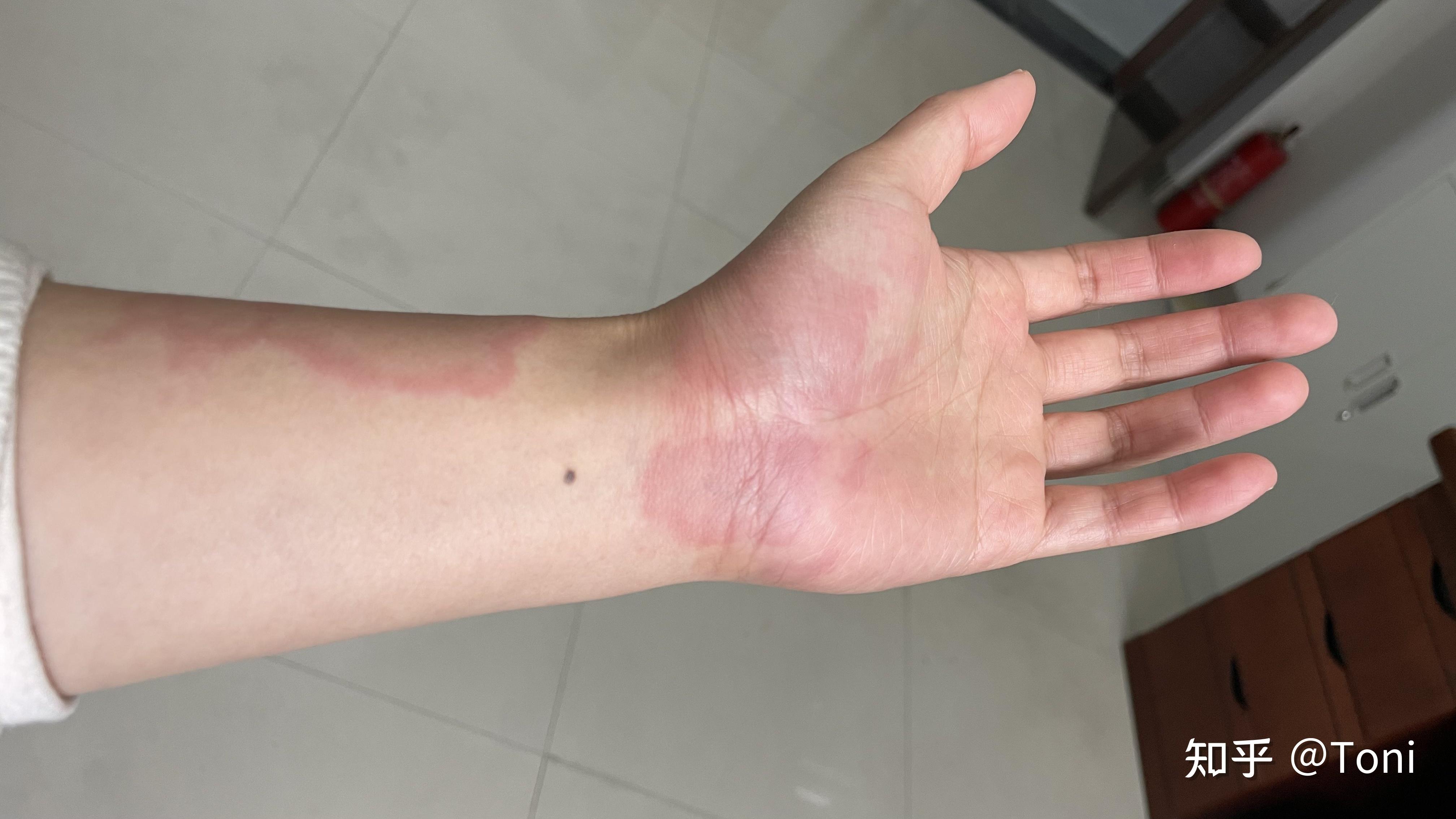 荨麻疹治疗记录