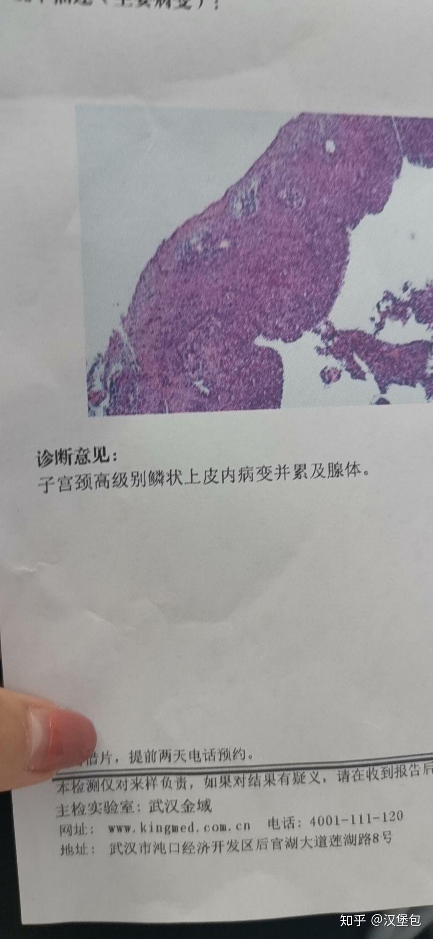 谈谈我的宫颈癌治疗过程