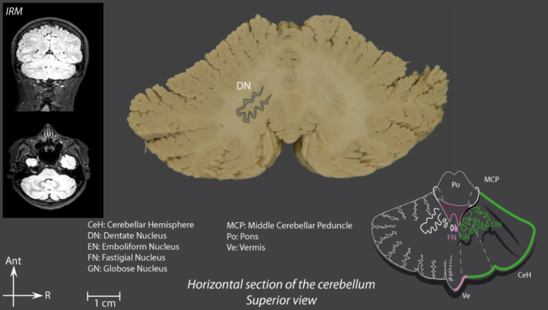 小脑磁共振解剖图像图片