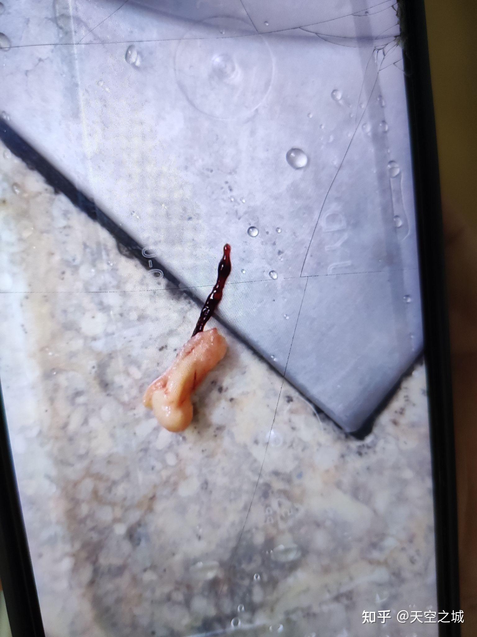 药流有残留未清宫结果让人欣喜