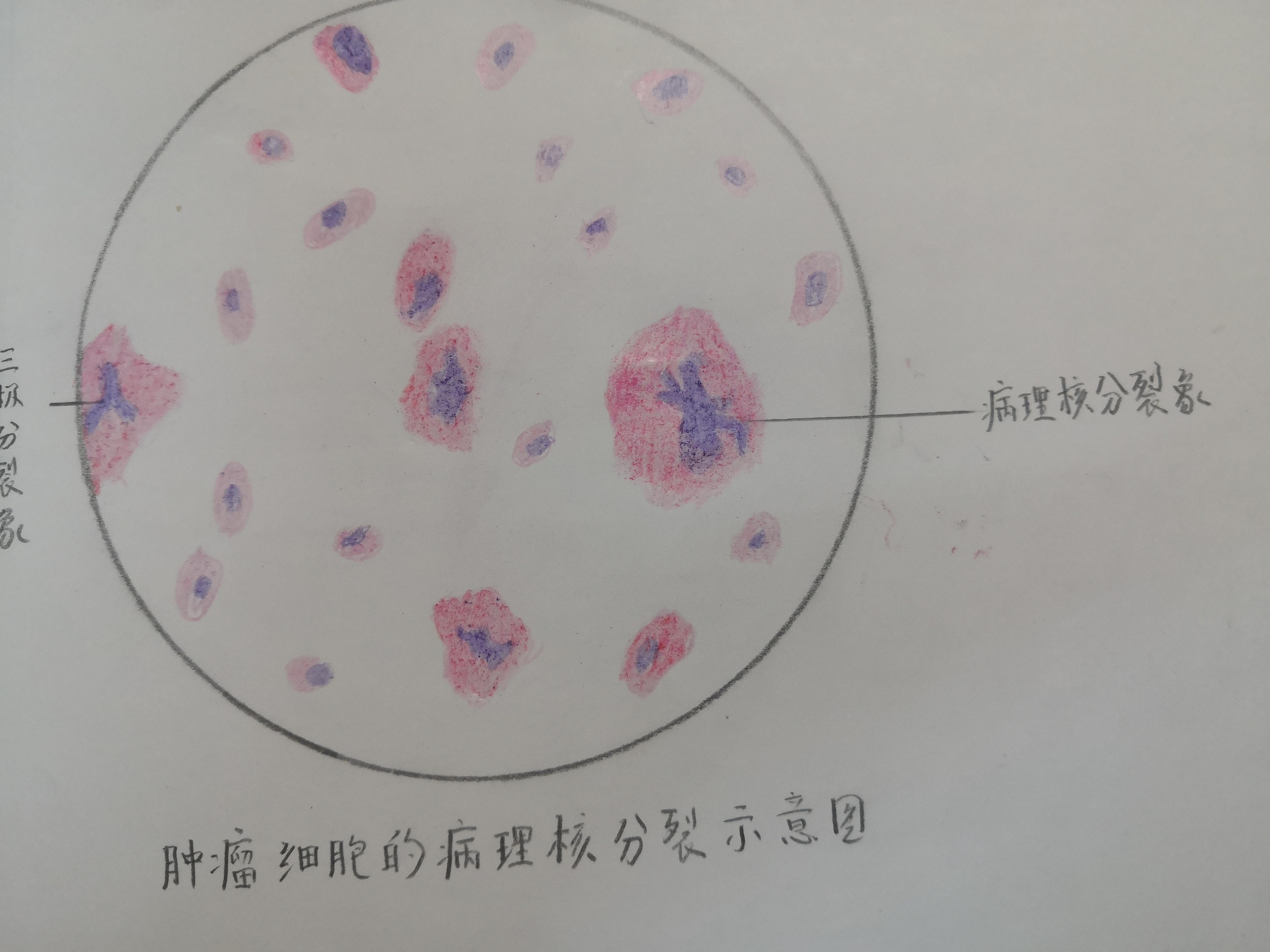 灰色肝样变期肝硬化慢性肾小球肾炎葡萄胎更新最后两张图流脑结核结节
