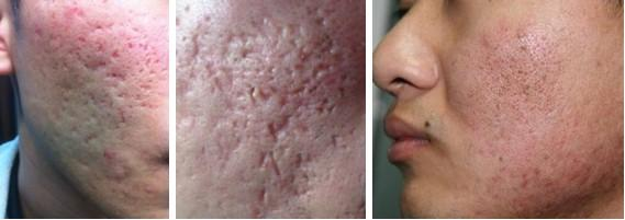 有了痘坑疤痕组织后要比正常皮肤衰老的快