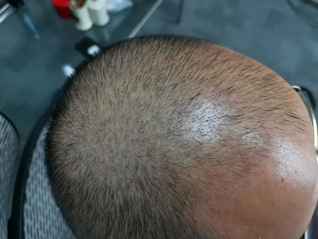 对于肆无忌惮的脱发,是时候让它留在回忆里啦! - 知乎