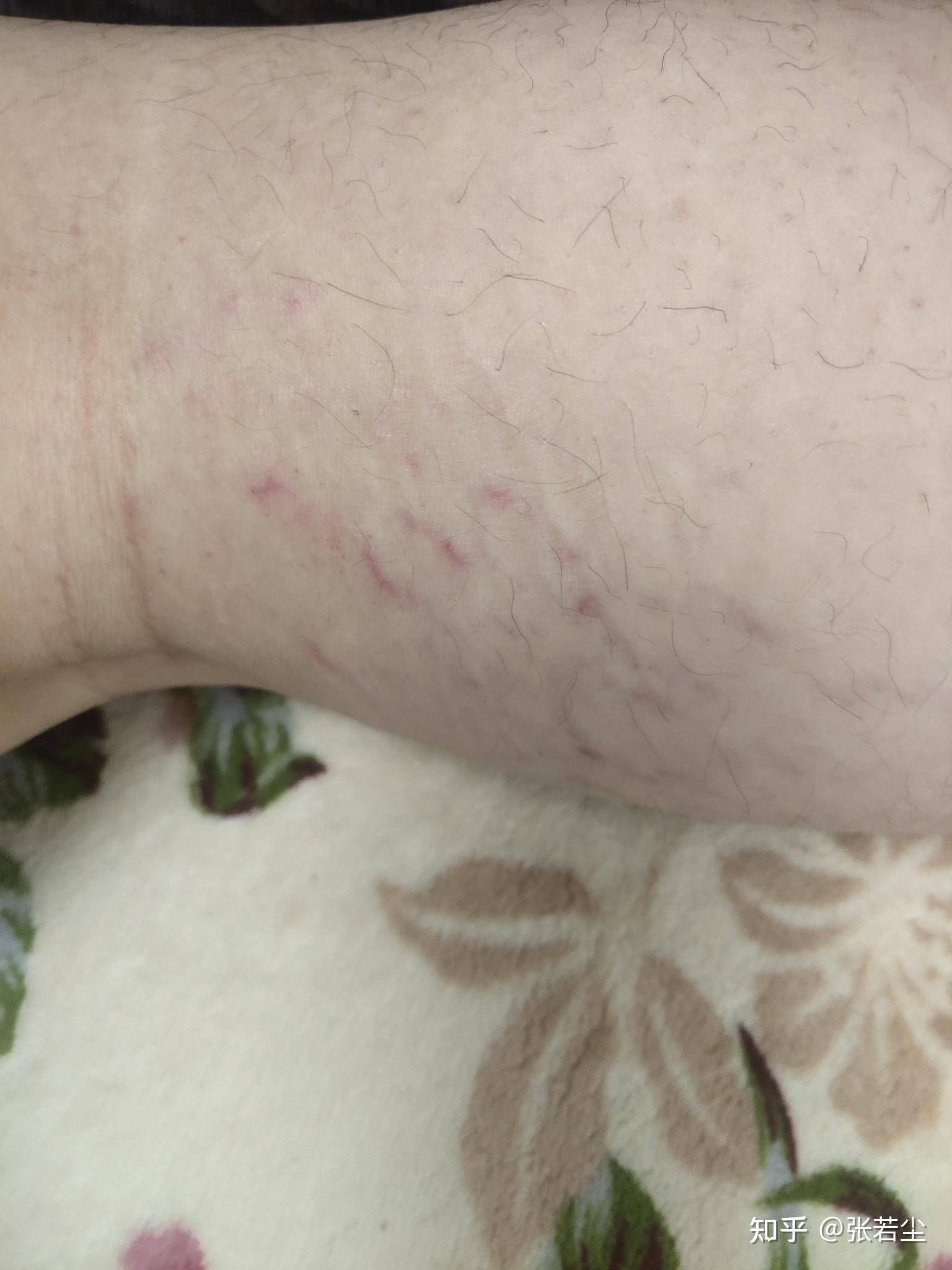 腿上有红血丝 - 知乎