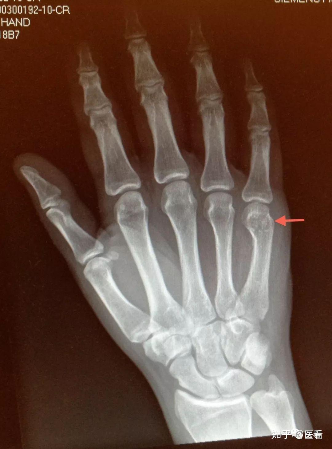 病例2:第五掌骨远端骨折,也称boxer骨折病例1:尺骨鹰嘴骨折