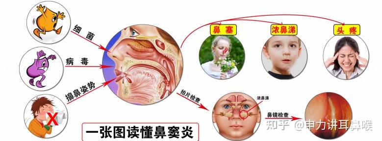 鼻屎是怎么形成的图片