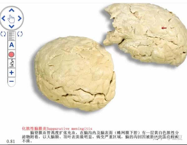 病理-化脓性脑膜炎（表面化脓） - 知乎