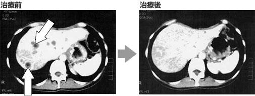 全身转移的晚期胃癌病灶全部消失 全因体内多了它 知乎