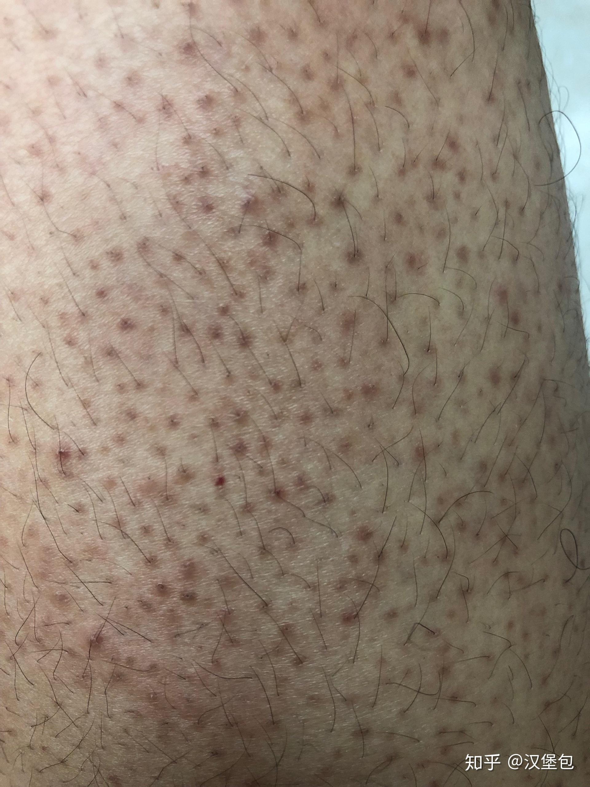 腿上长了很多小痘痘图片