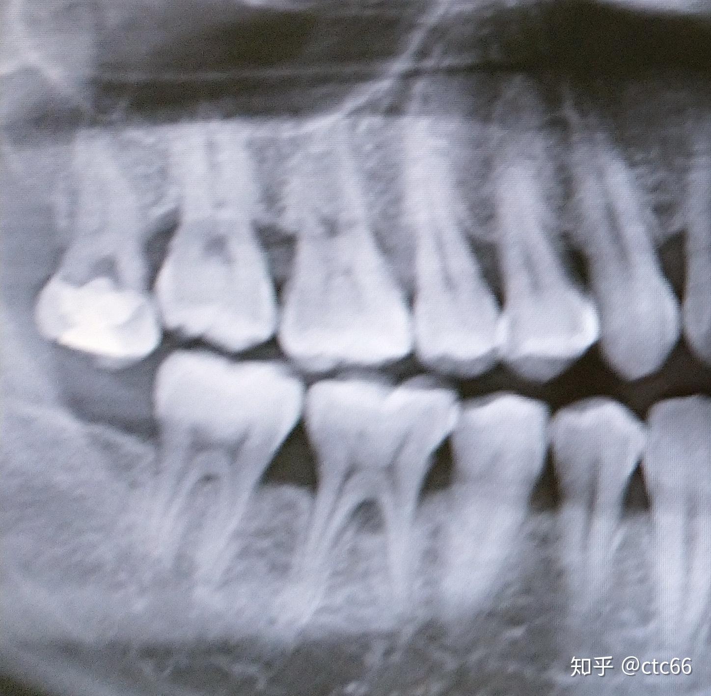 智齿,这种不仅伸长还蛀的一塌糊涂,还是早点拔掉吧如果是埋起来的上颌