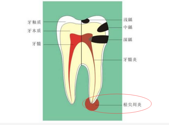 根管治疗疼不疼？深圳牙科