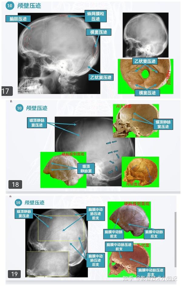 头颅X线摄影及其解剖 - 知乎