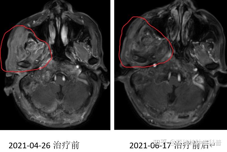 头颈癌放化疗失败陷绝境,免疫治疗显奇功—— 一例扁桃体鳞癌病例 - 知乎