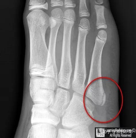 骨骺内多发骨化中心造成的,常表现为外缘光滑,边界清晰