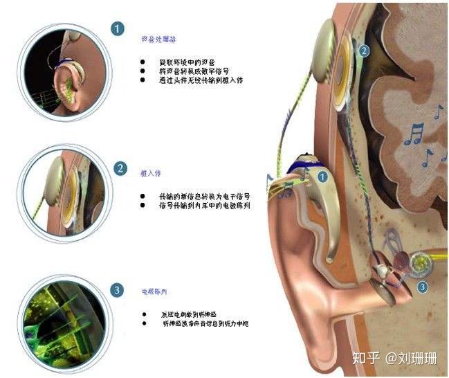 什么是人工耳蜗手术