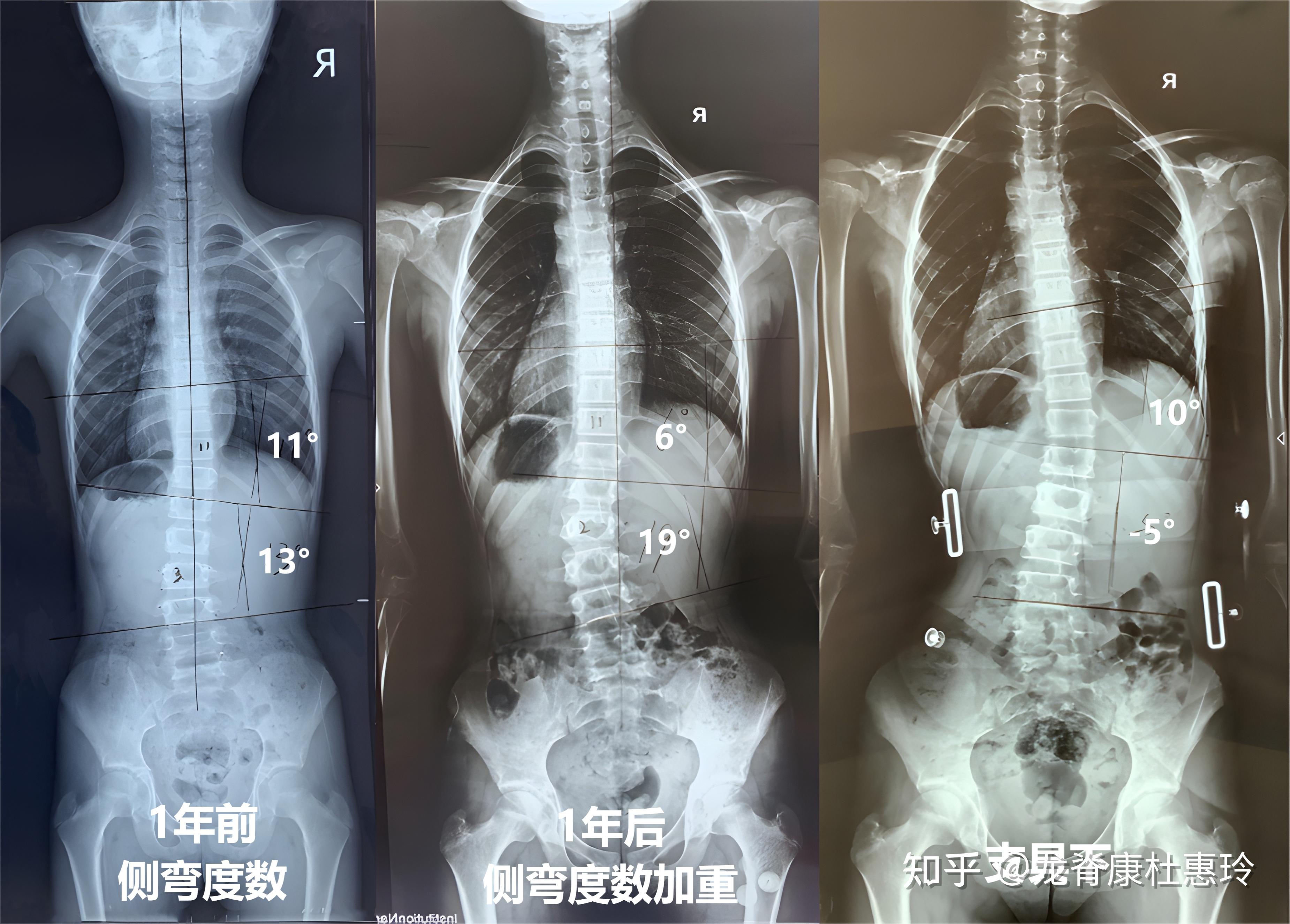 12岁侧弯女孩,治疗3个月后剃刀背从8°减至0°,如何做到的? - 知乎