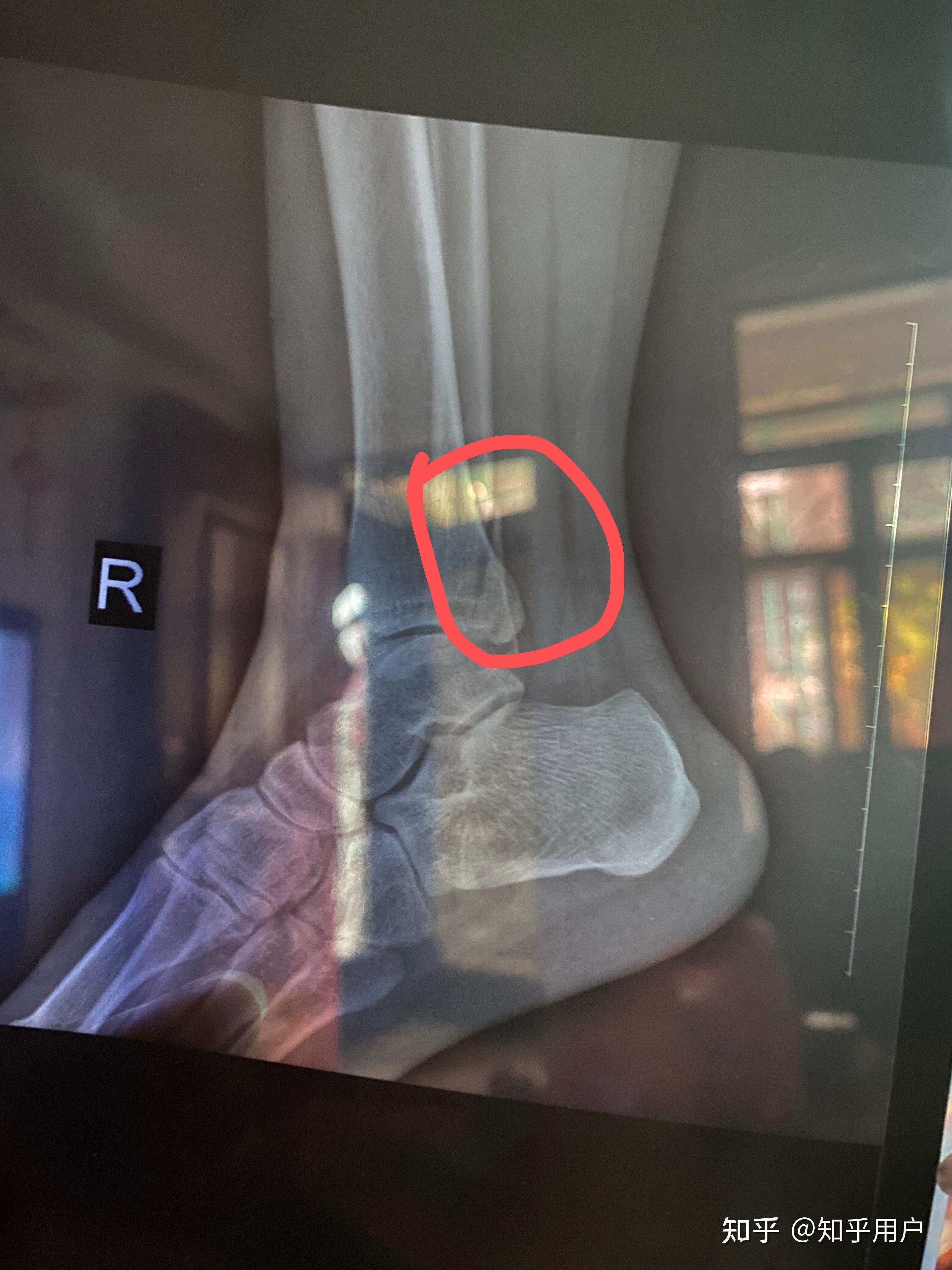 记录外脚踝骨折恢复过程… 