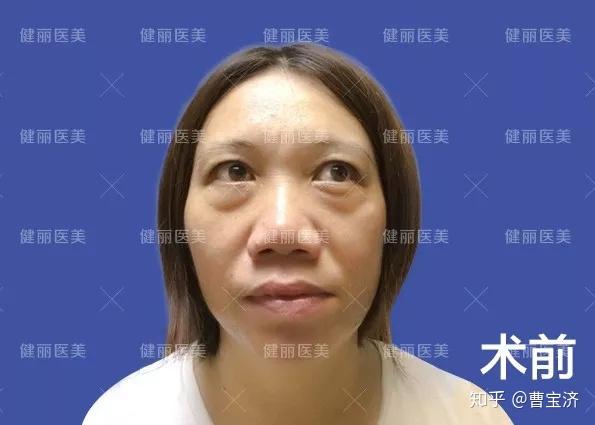 55岁女士去眼袋失败 饱受折磨长达3年多 知乎