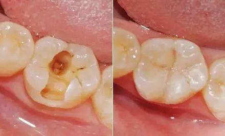 为什么益生菌能帮你治口臭?