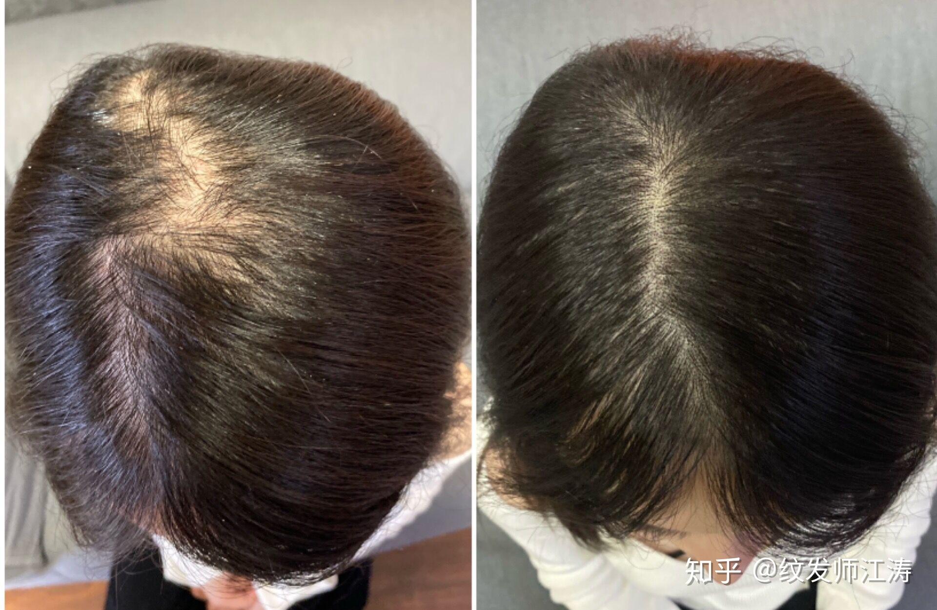 纹发际线适合女生发际线高,适当调整发际线的位置和形状说了这些