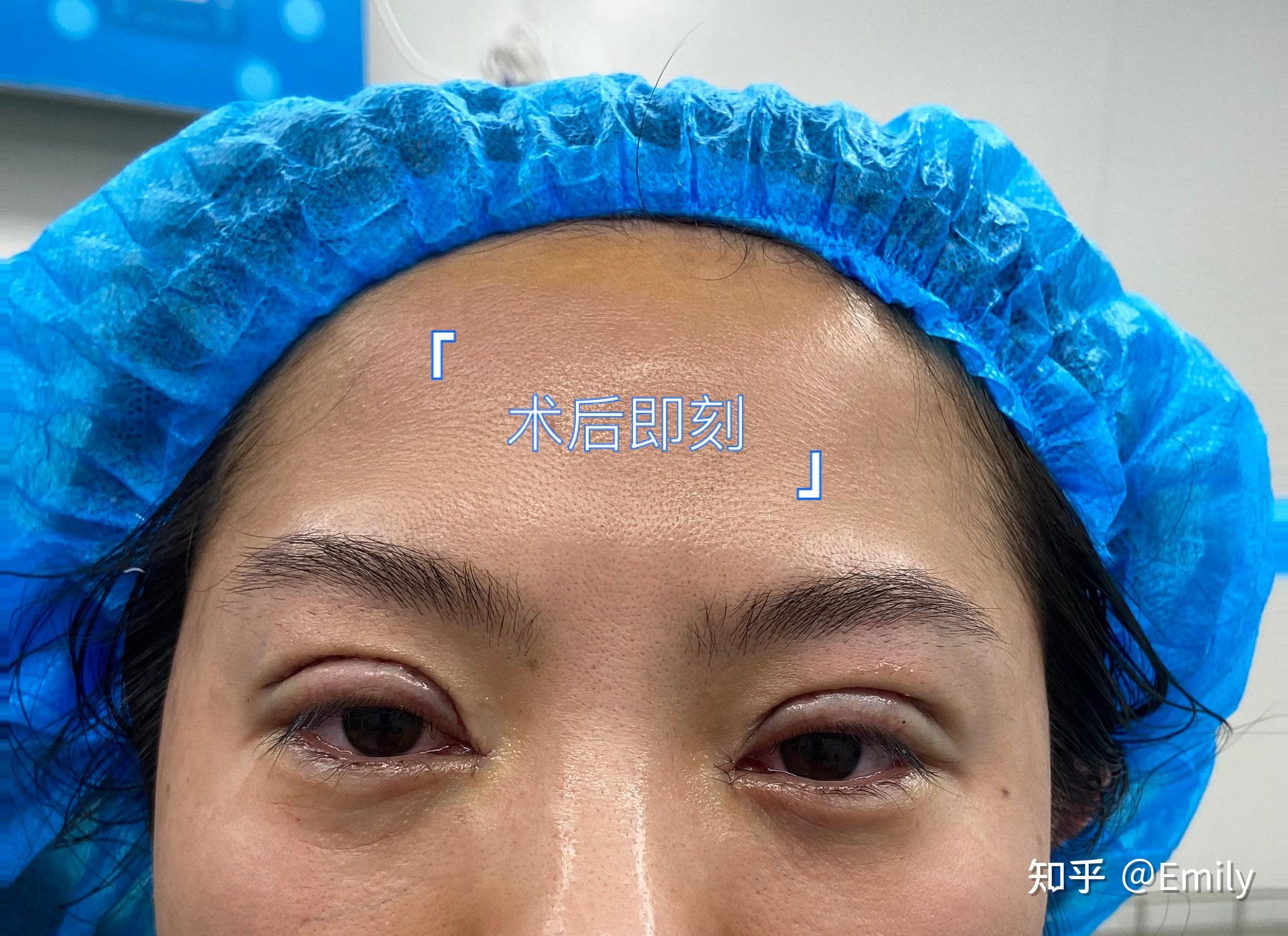 王太玲医生三点微创双眼皮案例分享-1-5 - 好大夫在线